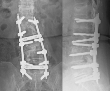 椎管減壓及融合術後的X光成像