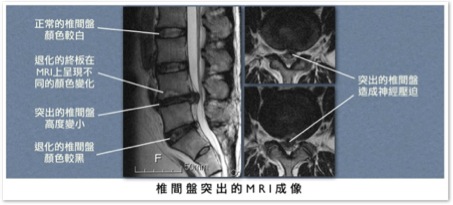 椎間盤突出的MRI成像