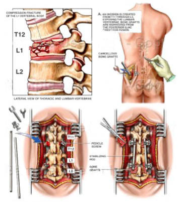 ORIF_spine_fx