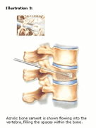 vertebroplasty-3