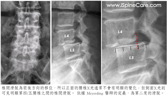 listhesis_diagnosis_1