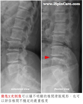 listhesis_diagnosis_2
