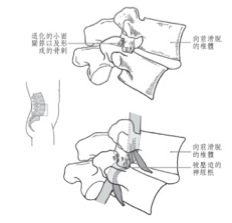 spondylolisthesis_sciatica_cs